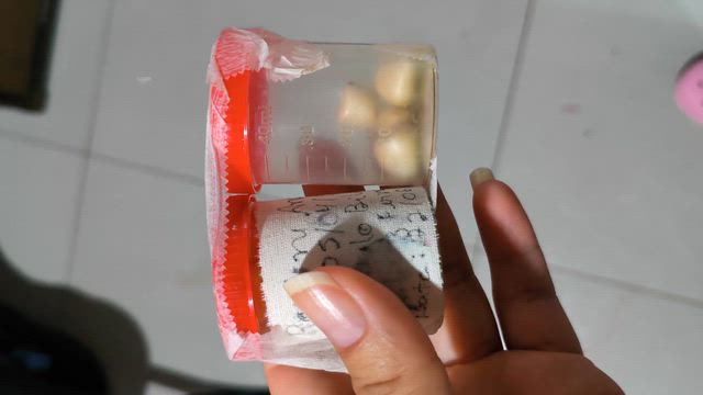 Imagem Pedra biliares humano